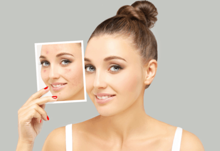 Cách trị mụn, thâm, sẹo hữu hiệu Cách trị mụn, thâm, sẹo hữu hiệu