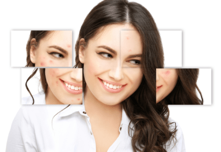 Hormone gây ra mụn như thế nào?