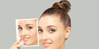 Cách trị mụn, thâm, sẹo hữu hiệu