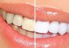 Bọc răng sứ và những điều cần biết để có bộ răng trắng đẹp