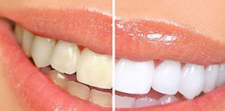 Bọc răng sứ và những điều cần biết để có bộ răng trắng đẹp