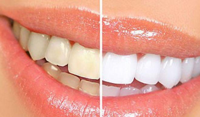 Bọc răng sứ và những điều cần biết để có bộ răng trắng đẹp