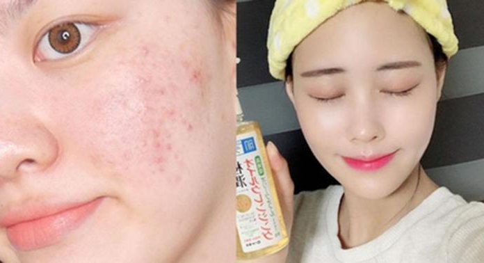 Dùng dầu tẩy trang mà mụn nổi ồ ạt: Sản phẩm không có tội, lỗi là do bạn không biết cách dùng