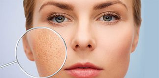 Để tránh nám da, các chị em cần nhớ ngay những “nguyên tắc vàng” này