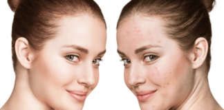 Hiểu rõ về các loại mụn để có cách điều trị đúng