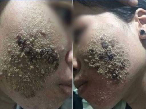 Khuôn mặt nổi từng mảng vì mê làm đẹp nhưng không rõ nguồn gốc, cô gái khiến CĐM xôn xao