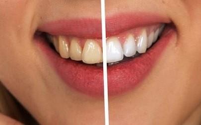 Mách bạn cách làm trắng răng tự nhiên hoàn toàn có thể tự làm mà không tốn một xu đến nha sĩ Mách bạn cách làm trắng răng tự nhiên hoàn toàn có thể tự làm mà không tốn một xu đến nha sĩ