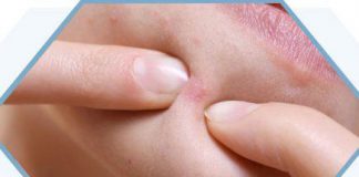 Mụn ẩn ở cằm là do đâu? Cách điều trị như thế nào?