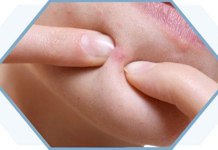 Mụn ẩn ở cằm là do đâu? Cách điều trị như thế nào? Mụn ẩn ở cằm là do đâu? Cách điều trị như thế nào?
