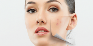 Phương pháp trị mụn nào hợp với bạn?