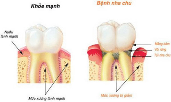 Cô gái 28 tuổi rụng răng, móm mém như cụ bà 80 vì thói quen xấu