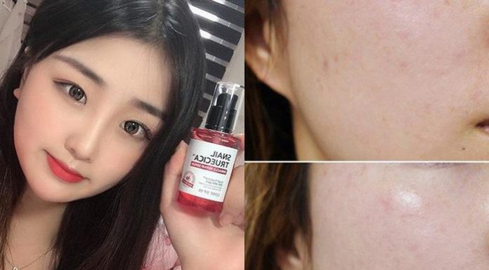 Serum nhầy ốc sên làm đầy sẹo rỗ “hot rần rần”, bạn sẽ biết nên mua hay không khi xem loạt review người thật việc thật này Serum nhầy ốc sên làm đầy sẹo rỗ "hot rần rần", bạn sẽ biết nên mua hay không khi xem loạt review người thật việc thật này