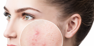 Sẹo thâm hai bên má: Làm sao để giải quyết?