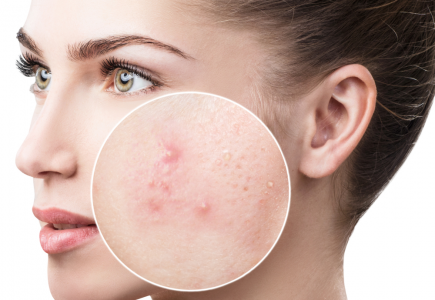 Sẹo thâm hai bên má: Làm sao để giải quyết?